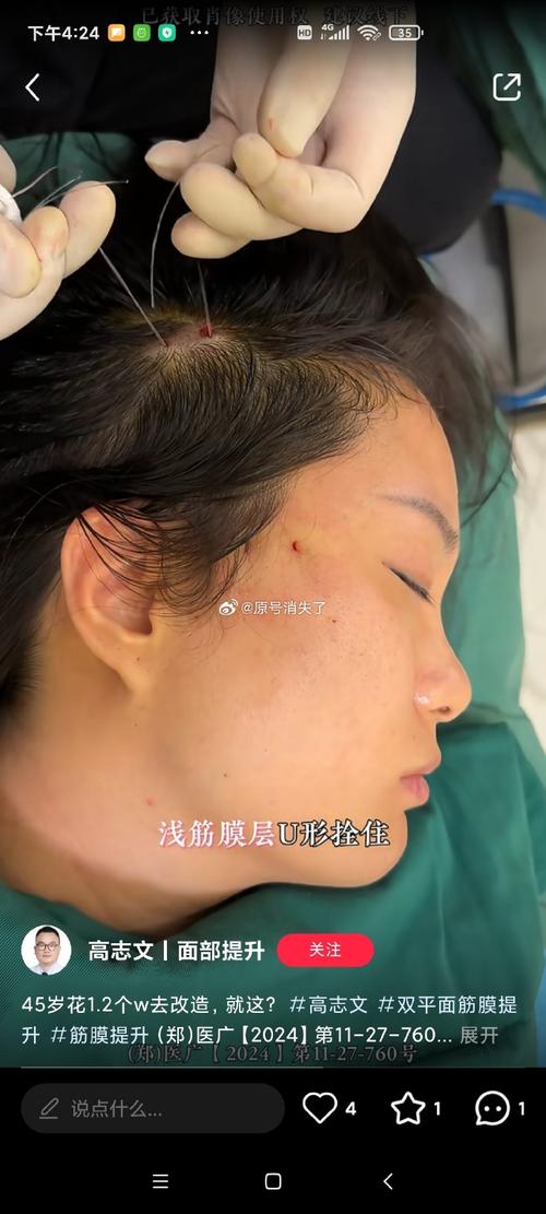 热5约不上，线雕又怕疼，这些新的医美技术你赶紧来围观！