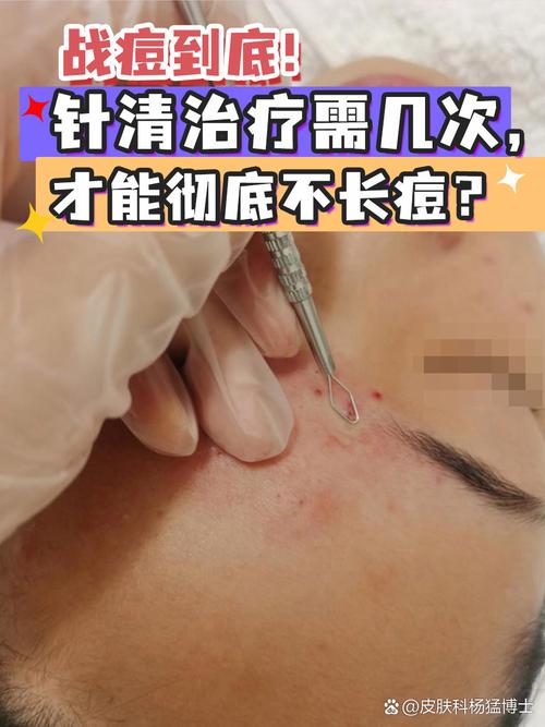 那些从不长痘的人,到底做了啥?